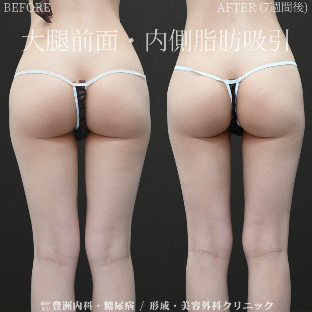 脂肪吸引（大腿内側・前面） / 20代女性