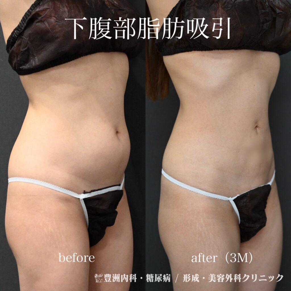 下腹部脂肪吸引 / 30代女性