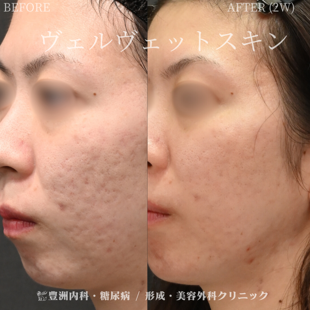ヴェルヴェットスキン / 20代女性