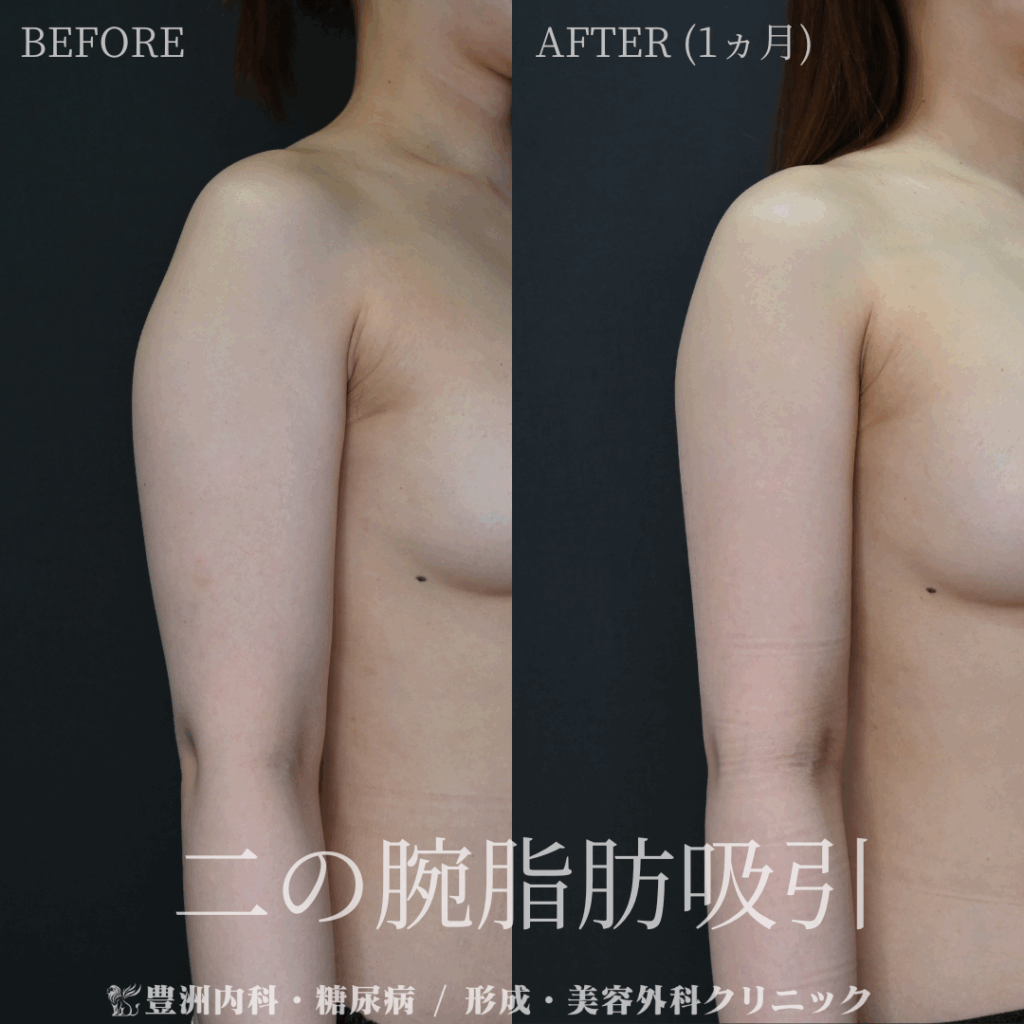 二の腕脂肪吸引 / 30代女性