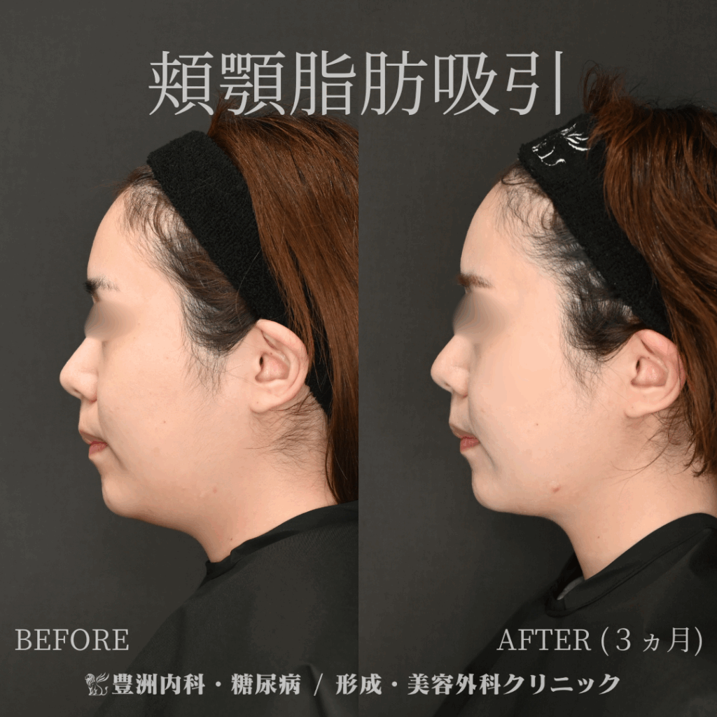 頬顎脂肪吸引 / 20代女性
