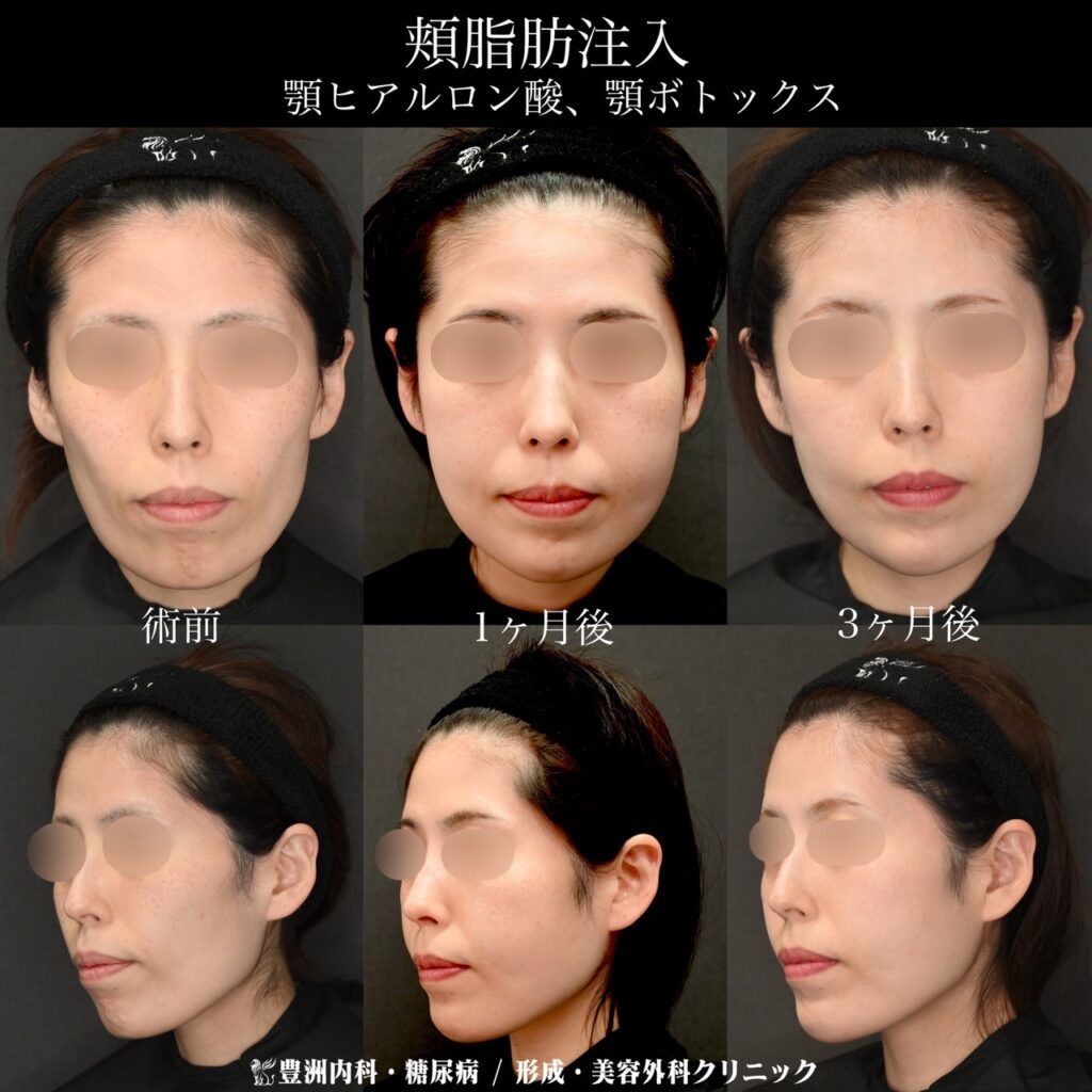 頬脂肪注入、顎ヒアルロン酸・ボトックス / 30代女性