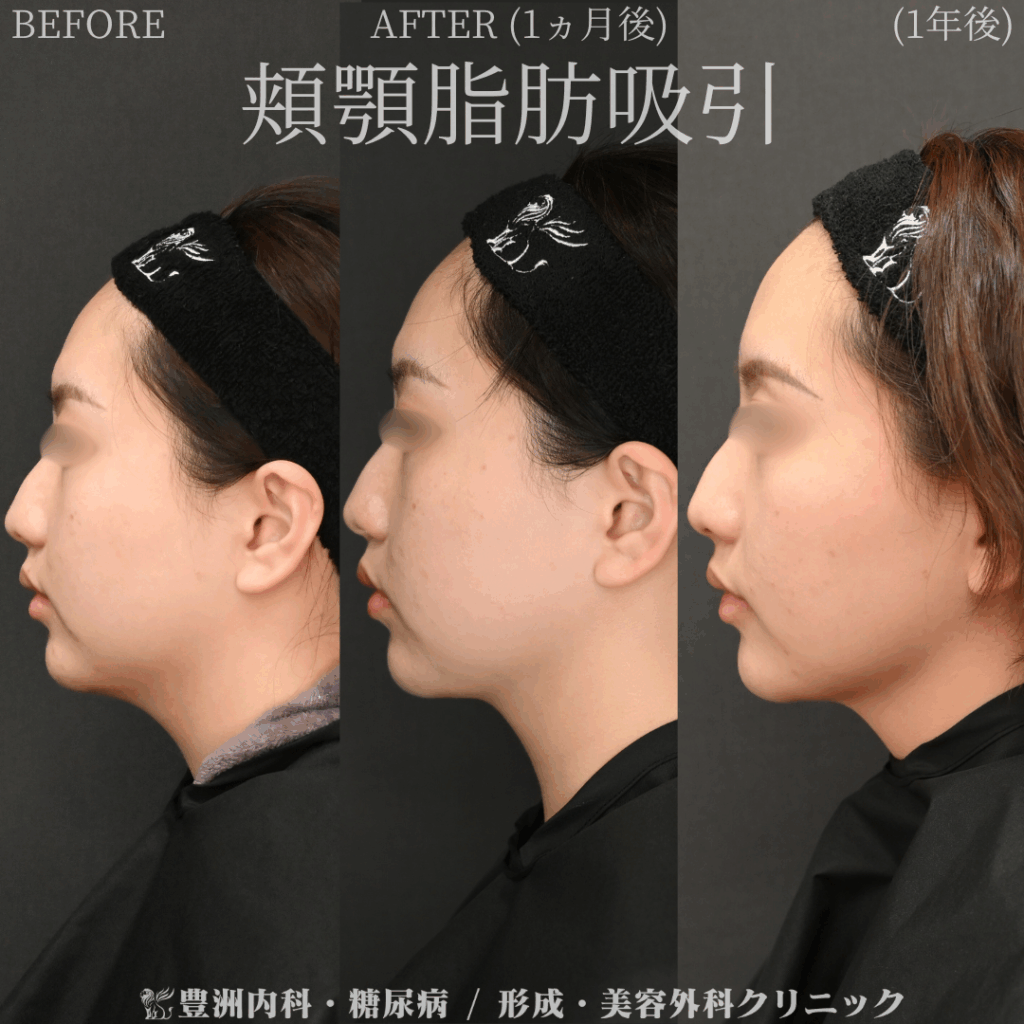 頬顎脂肪吸引 / 20代女性