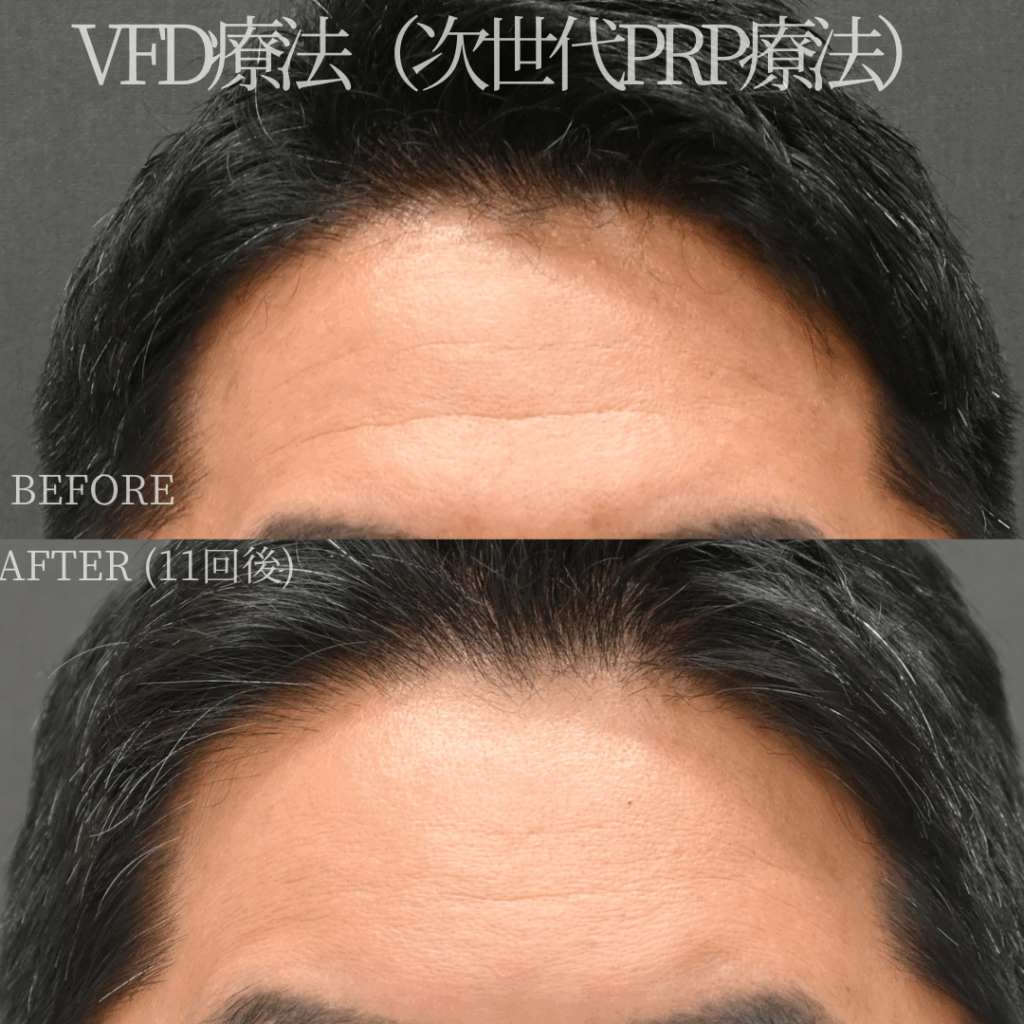 シワ治療（VFD®） / 40代男性