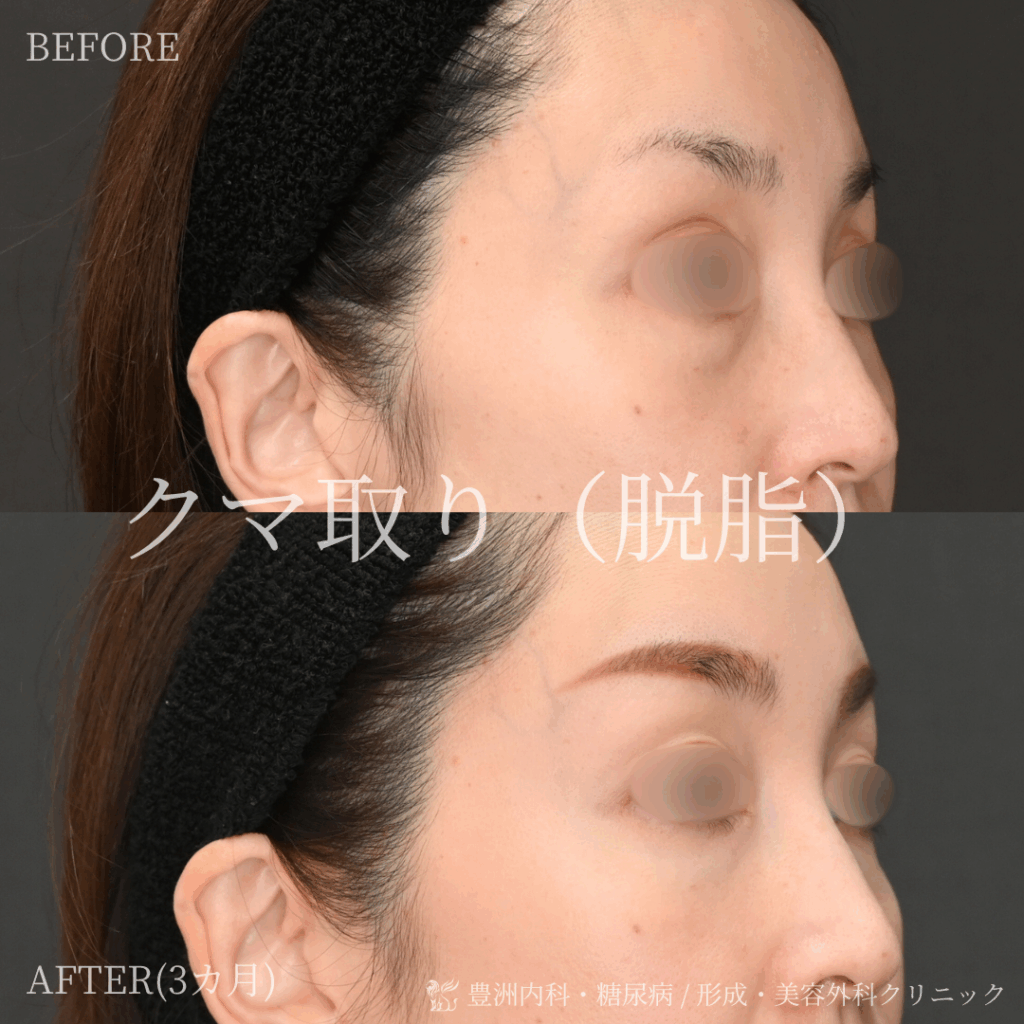 クマ取り / 40代女性